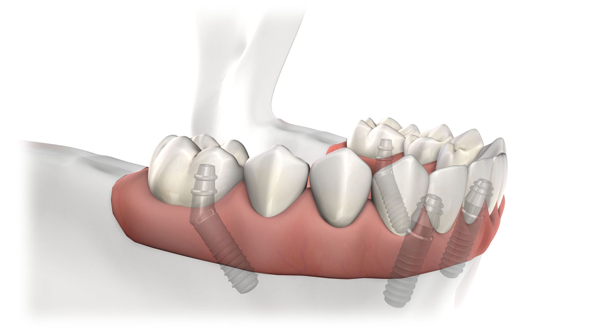 Dental Implants: The Best Denture Alternative Philly Has to Offer!