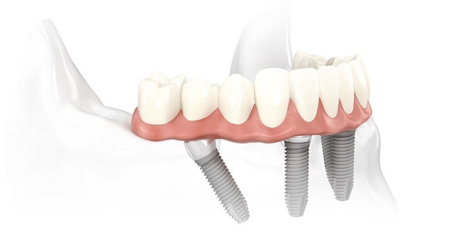 Philadelphia Implant Dentist Discusses The Implant-Supported All-on-4® Treatment Concept for Denture Replacement