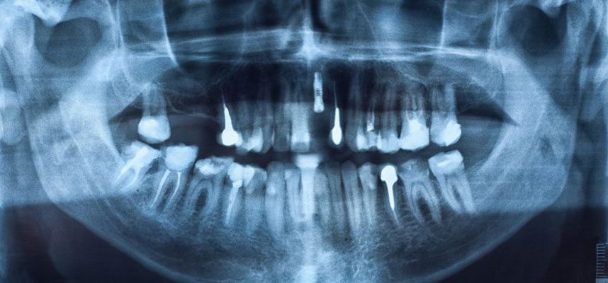 Considering Dental Implants?