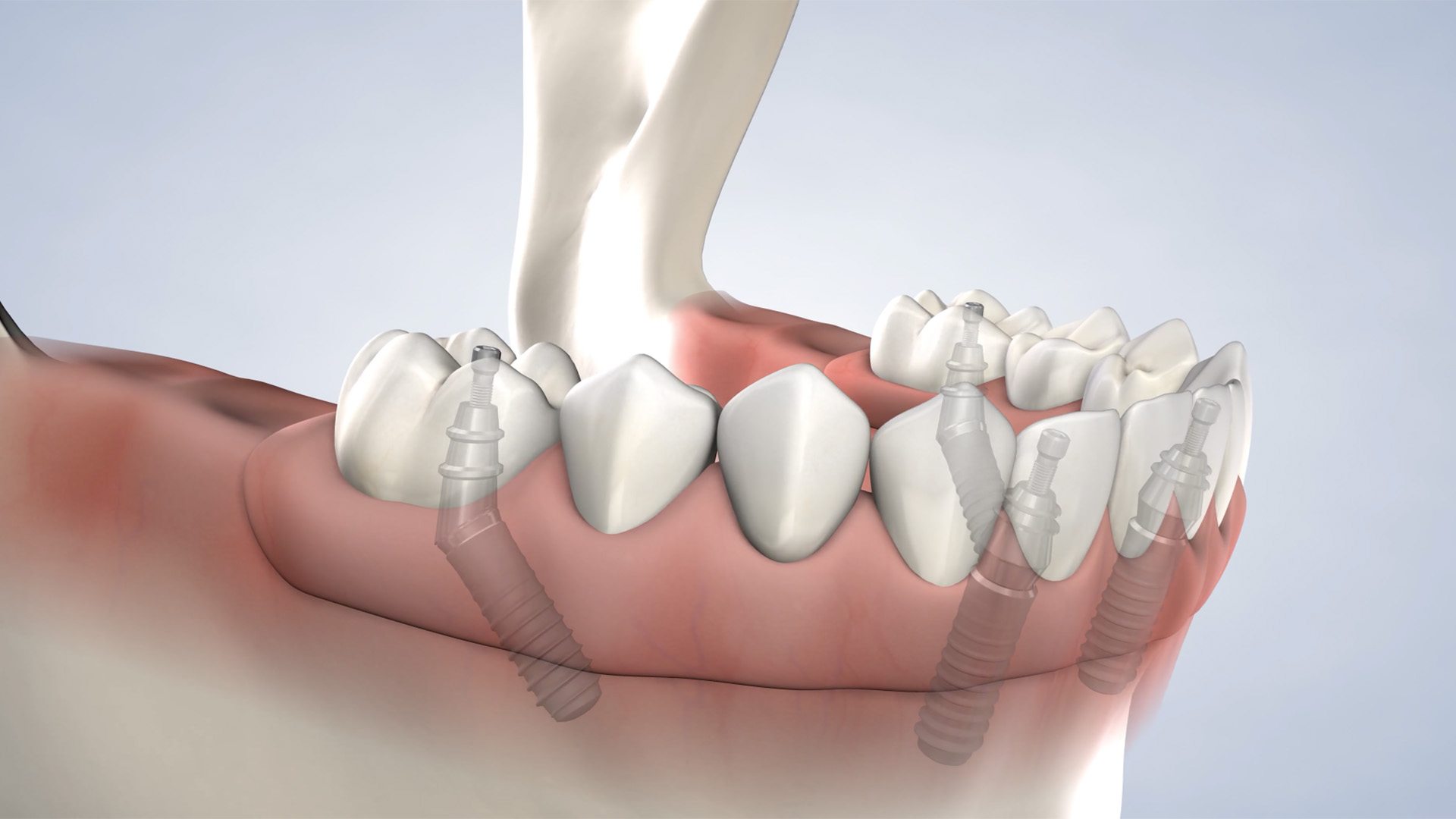 How Philadelphia Implant Dentists Offer Natural-Looking Dental Implants