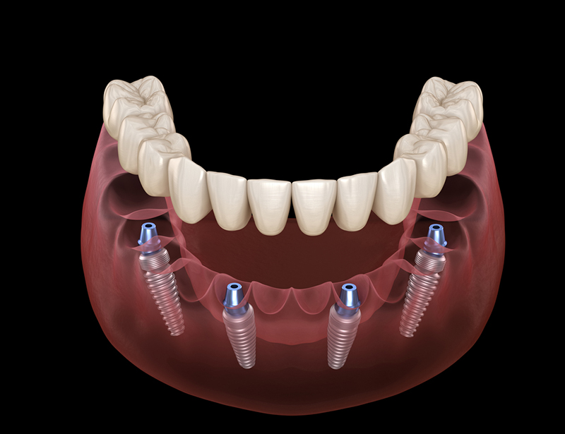dental implant All-on-4 illustration