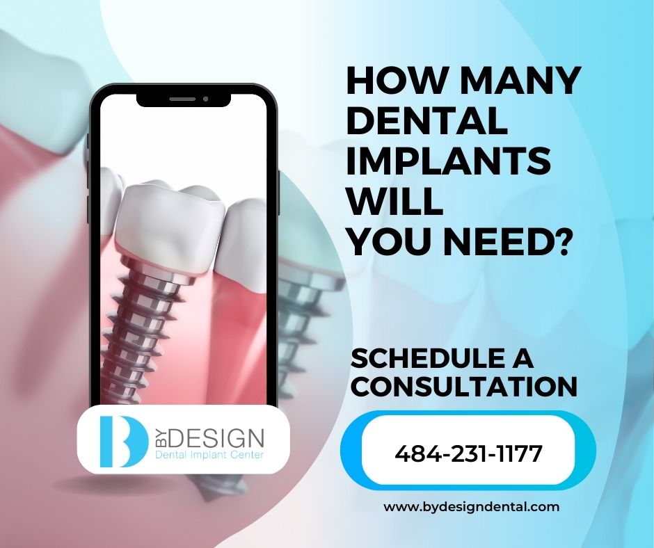 How many dental implants will you need?